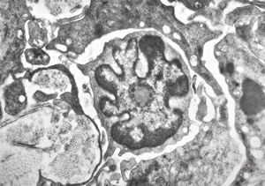 F, 36y. | Sézary-like cell - generalized eruptive histiocytoma